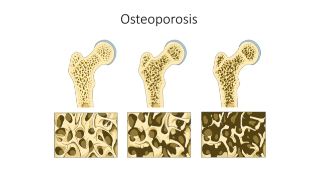 Osteopeni Nedir? Belirtileri, Nedenleri ve Tedavisi