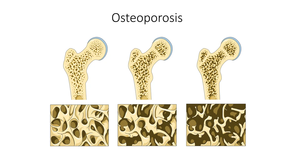 Kemik yapısını gösteren osteopeni ve osteoporoz illüstrasyonu — sağlıklı kemikten gözenekli kemiğe geçiş