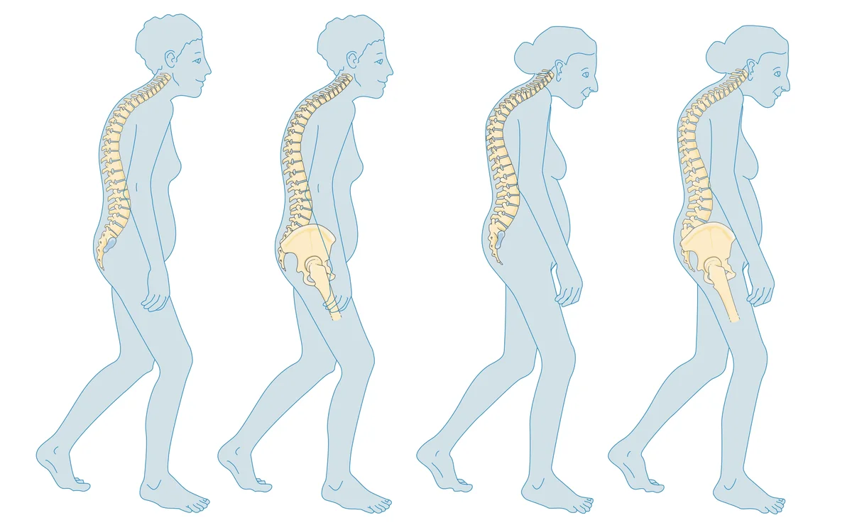 Osteoporoza bağlı omurga eğriliği ve duruş değişiminin ilerleyişini gösteren tıbbi illüstrasyon
