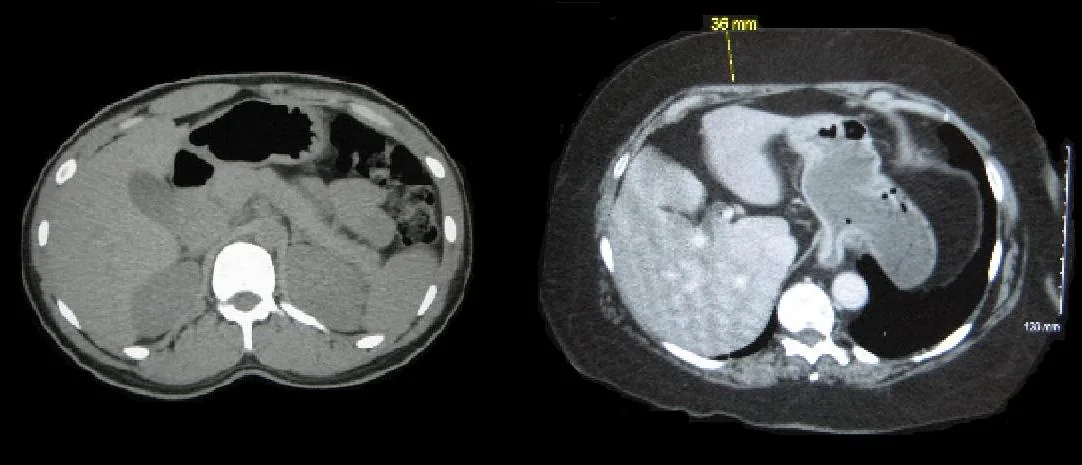 Normal ağırlıklı kişi ile obez kişinin abdominal BT görüntüsü karşılaştırması: sağ tarafta visseral yağın iç organları sardığı açıkça görülmektedir