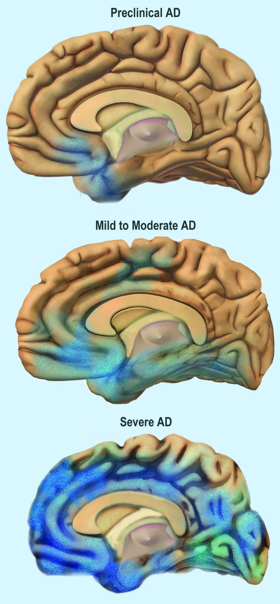 Alzheimer hastalığının preklinik, hafif-orta ve ileri evrelerinde beyinde hasarın entorinal korteks ve hipokampustan tüm kortekse yayılışını gösteren beyin kesiti diyagramı
