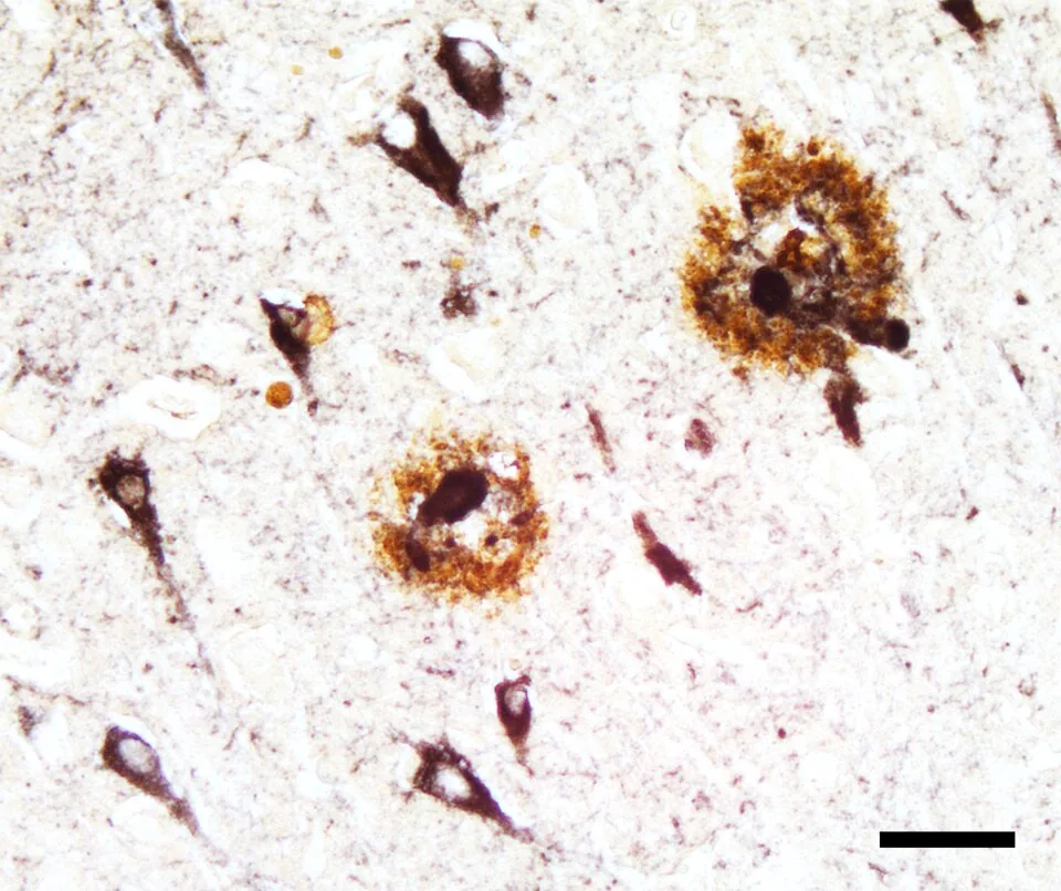 Alzheimer beyin dokusunda kahverengi amiloid-beta plakları ile siyah tau nörofibriler yumaklarını birlikte gösteren çift immünohistokimyasal boyama görüntüsü