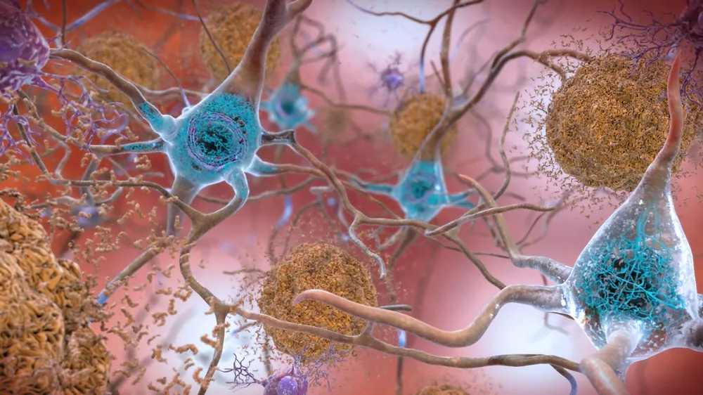 Nöronlar, sinaptik bağlantılar ile beta-amiloid plakları ve tau proteinini gösteren, beyin sağlığı ve Alzheimer bağlamına uygun bilimsel illüstrasyon