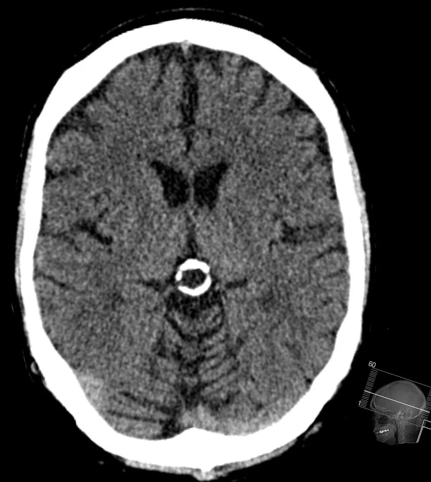 Kafa tomografisinde (BT) orta hatta parlak beyaz bir nokta olarak görünen, kireçlenmiş epifiz bezi/pineal kist