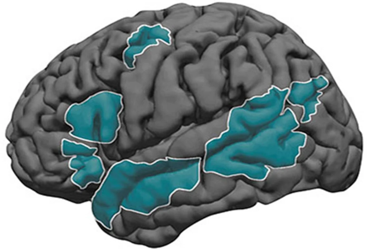Beynin dil ağını oluşturan alın (frontal) ve şakak (temporal) lob bölgelerinin turkuaz renkle işaretlendiği anatomik beyin diyagramı